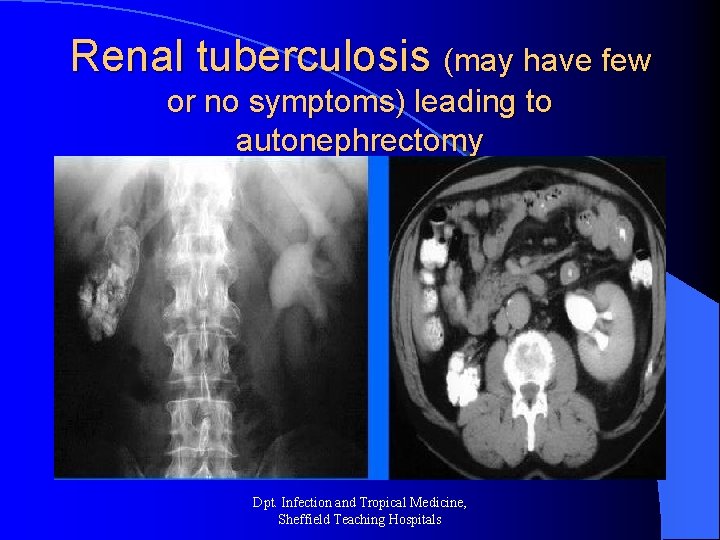 Renal tuberculosis (may have few or no symptoms) leading to autonephrectomy Dpt. Infection and