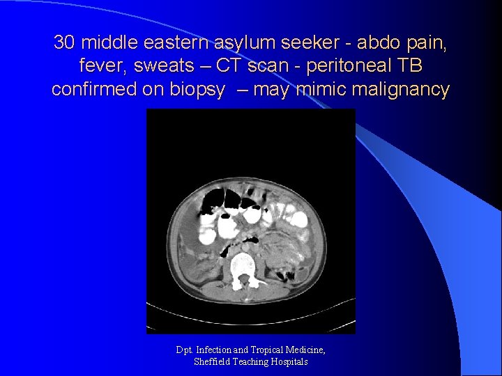 30 middle eastern asylum seeker - abdo pain, fever, sweats – CT scan -