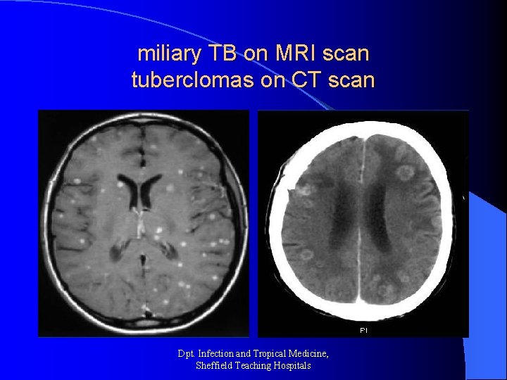 miliary TB on MRI scan tuberclomas on CT scan Dpt. Infection and Tropical Medicine,