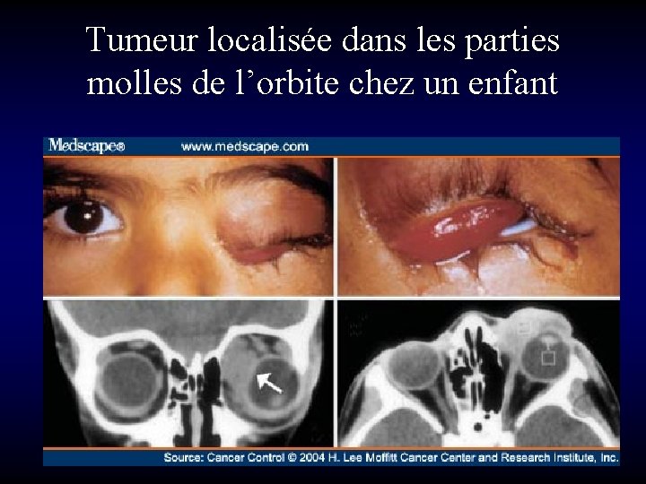 Tumeur localisée dans les parties molles de l’orbite chez un enfant 