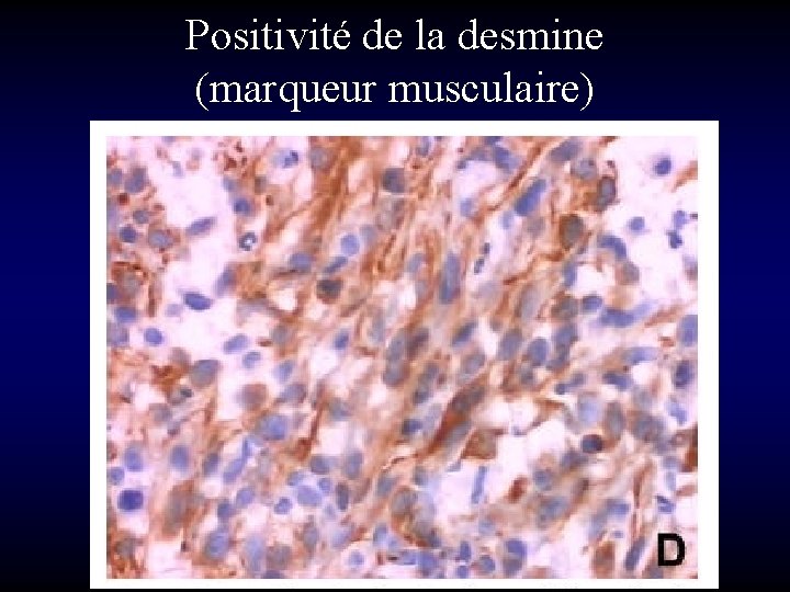 Positivité de la desmine (marqueur musculaire) 