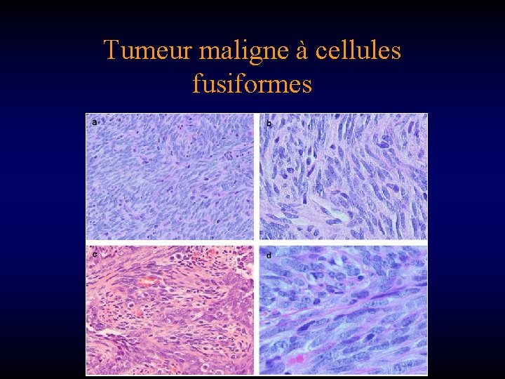 Tumeur maligne à cellules fusiformes 