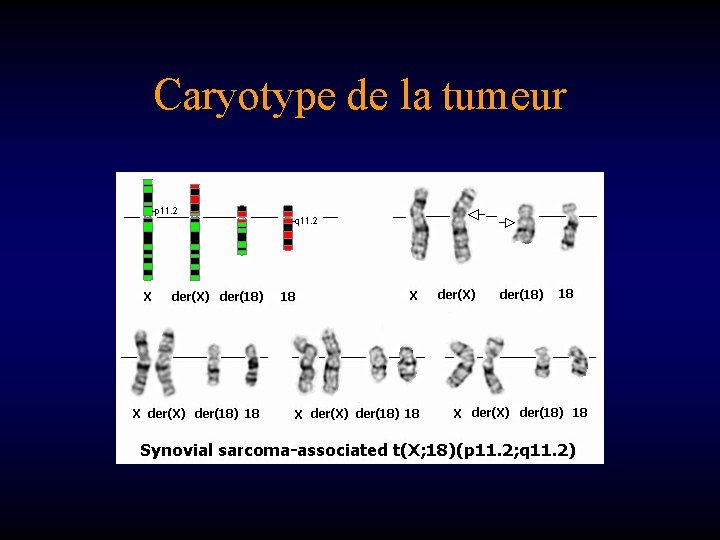 Caryotype de la tumeur 