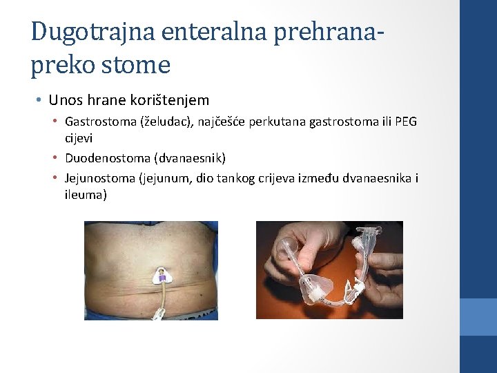 Dugotrajna enteralna prehranapreko stome • Unos hrane korištenjem • Gastrostoma (želudac), najčešće perkutana gastrostoma