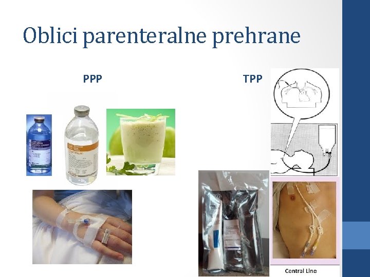 Oblici parenteralne prehrane PPP TPP 