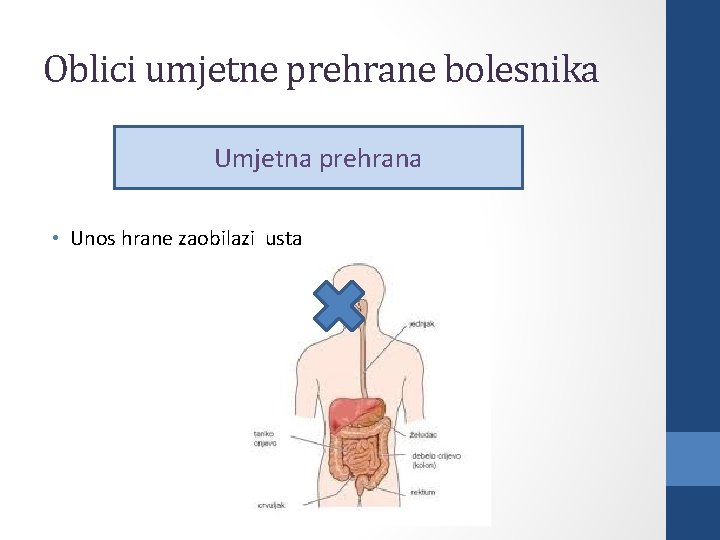 Oblici umjetne prehrane bolesnika Umjetna prehrana • Unos hrane zaobilazi usta 