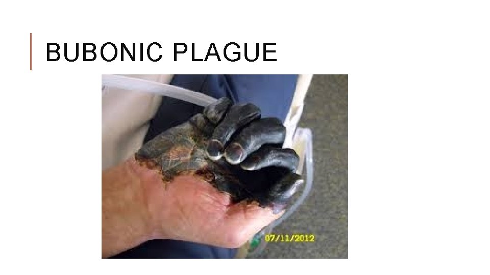 BUBONIC PLAGUE 