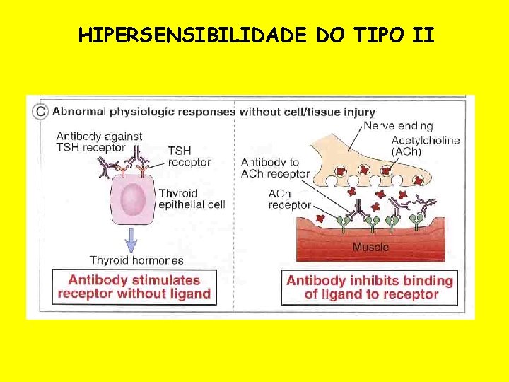HIPERSENSIBILIDADE DO TIPO II 