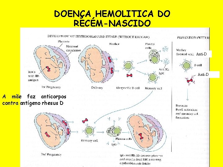 DOENÇA HEMOLITICA DO RECÉM-NASCIDO Anti-D A mãe faz anticorpos contra antígeno rhesus D 