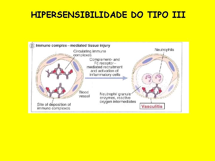 HIPERSENSIBILIDADE DO TIPO III 