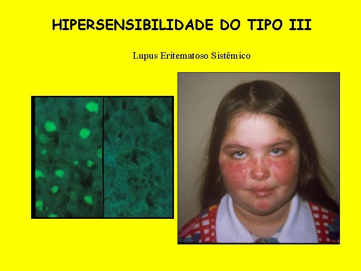 HIPERSENSIBILIDADE DO TIPO III Lupus Eritematoso Sistêmico 