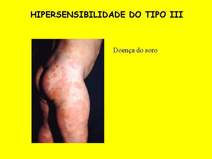 HIPERSENSIBILIDADE DO TIPO III Doença do soro 