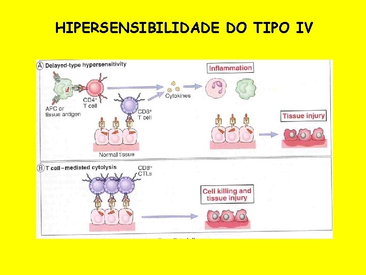 HIPERSENSIBILIDADE DO TIPO IV 