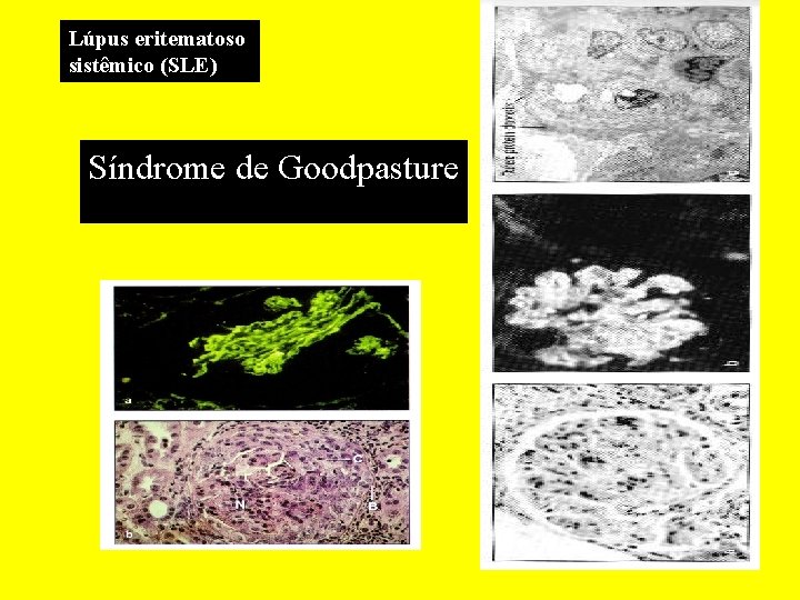 Lúpus eritematoso sistêmico (SLE) Síndrome de Goodpasture 