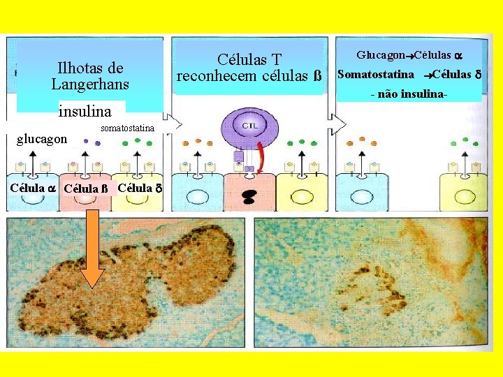 Ilhotas de Langerhans insulina glucagon somatostatina Célula ß Células T reconhecem células ß Glucagon