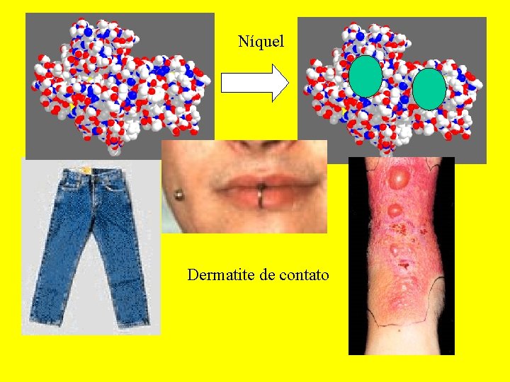 Níquel Dermatite de contato 