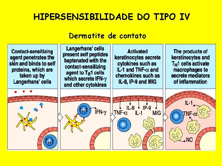 HIPERSENSIBILIDADE DO TIPO IV Dermatite de contato 