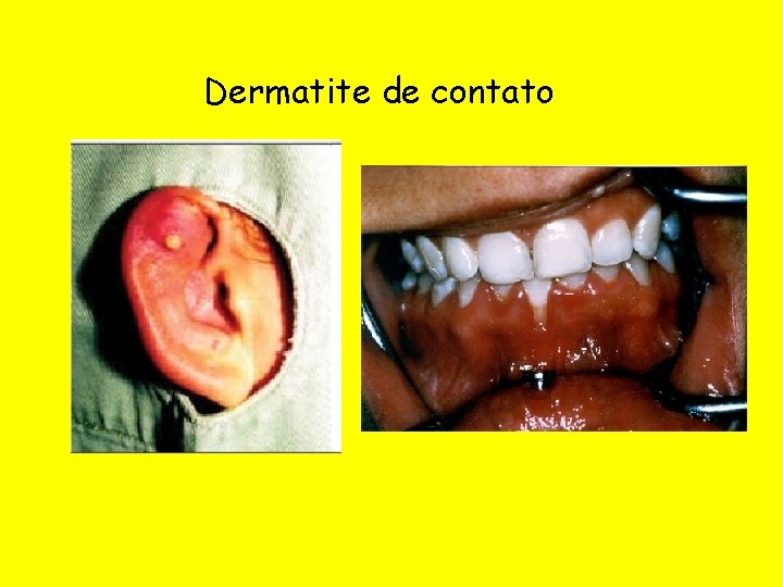 Dermatite de contato 