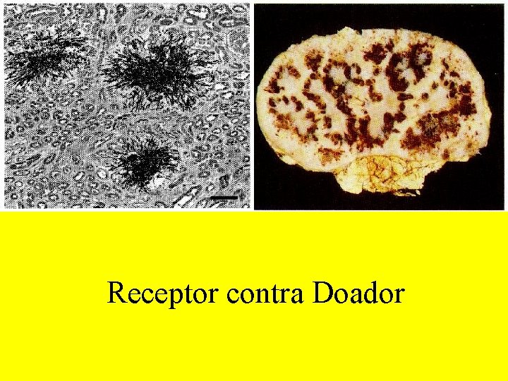 Receptor contra Doador 