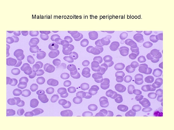 Malarial merozoites in the peripheral blood. 