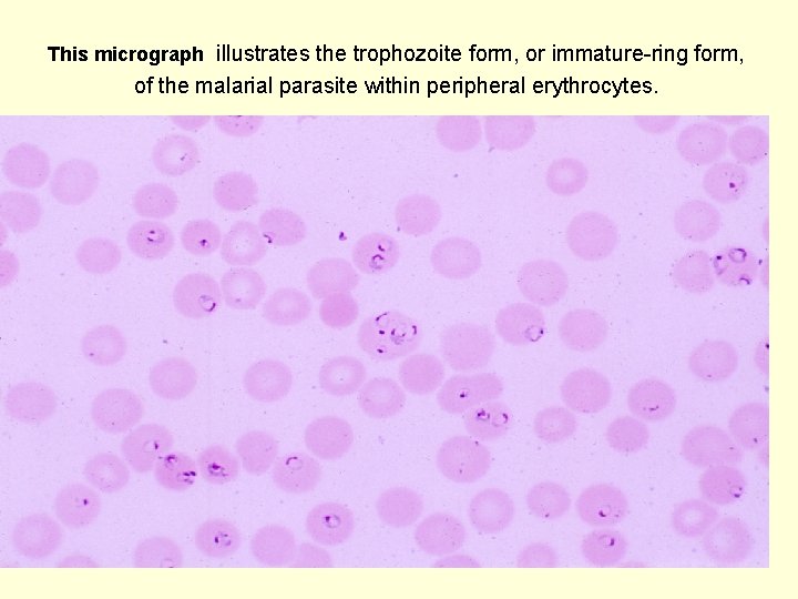 This micrograph illustrates the trophozoite form, or immature-ring form, of the malarial parasite within