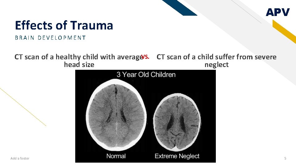 Effects of Trauma APV BRAIN DEVELOPMENT CT scan of a healthy child with average.