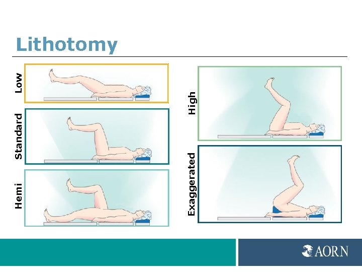 Low High Standard Exaggerated Hemi Lithotomy 