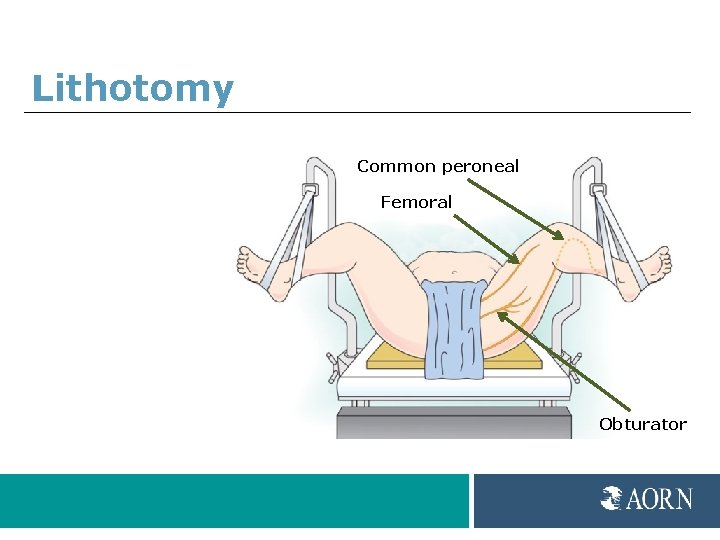 Lithotomy Common peroneal Femoral Obturator 