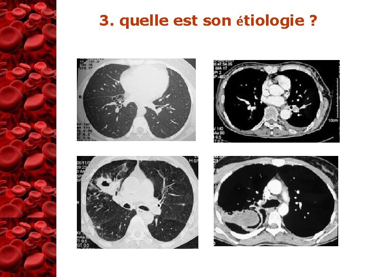 3. quelle est son étiologie ? 