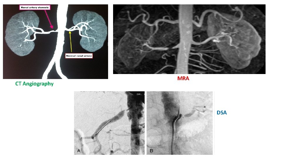 CT Angiography MRA DSA 