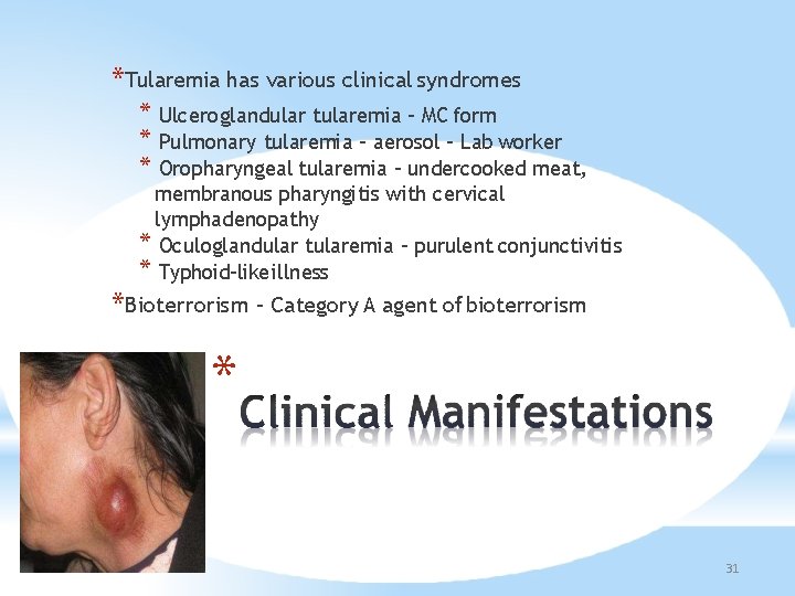 *Tularemia has various clinical syndromes * Ulceroglandular tularemia – MC form * Pulmonary tularemia