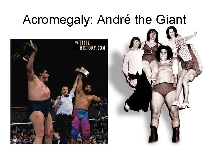 Acromegaly: André the Giant 