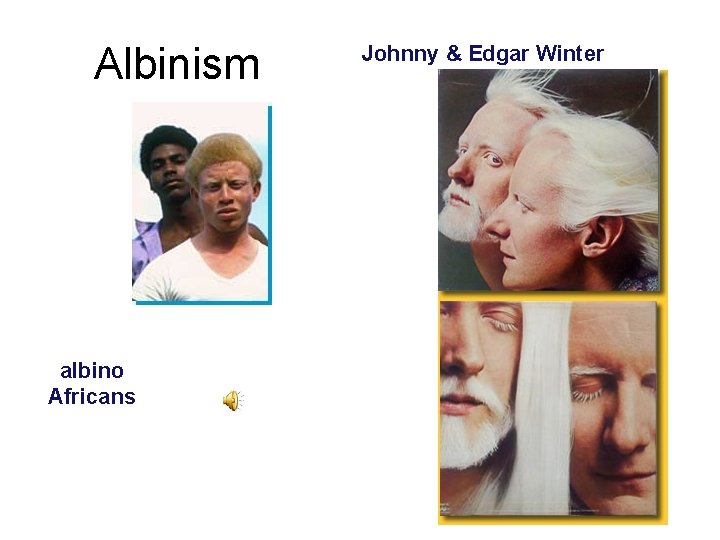 Albinism albino Africans Johnny & Edgar Winter 