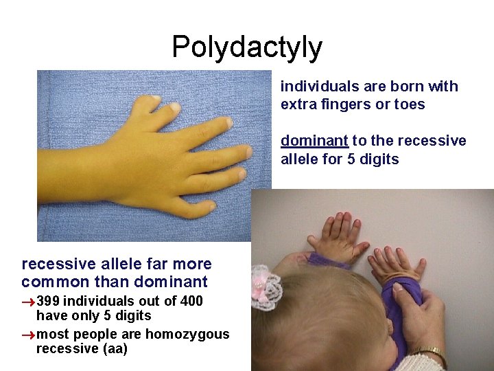 Polydactyly individuals are born with extra fingers or toes dominant to the recessive allele