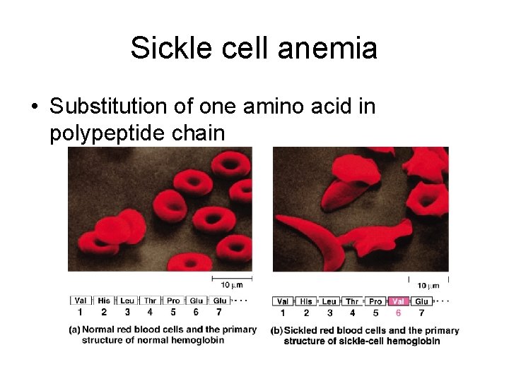 Sickle cell anemia • Substitution of one amino acid in polypeptide chain 