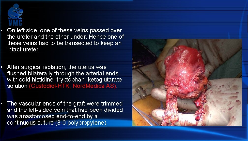  • On left side, one of these veins passed over the ureter and