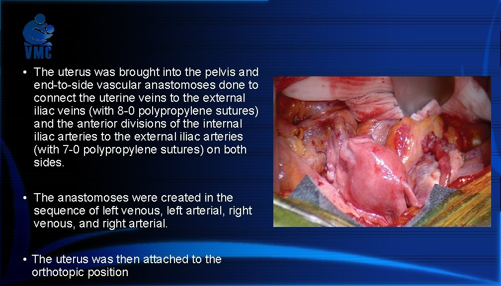  • The uterus was brought into the pelvis and end-to-side vascular anastomoses done