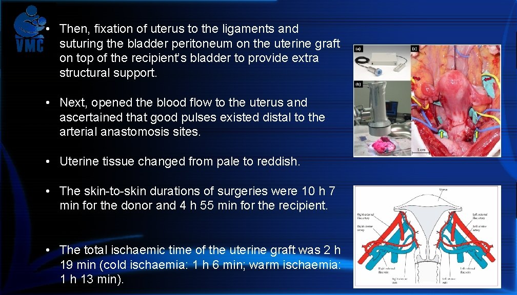  • Then, fixation of uterus to the ligaments and suturing the bladder peritoneum