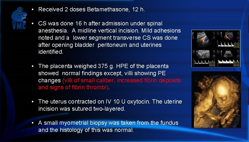  • Received 2 doses Betamethasone, 12 h. • CS was done 16 h