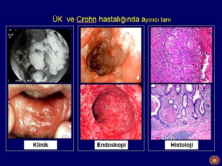 İnflamatuar barsak hastalığı Crohn hastalığı Ülseratif kolit İndeterminate colitis 