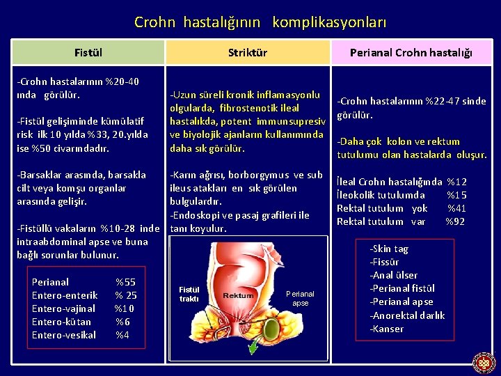 Crohn hastalığının komplikasyonları Fistül Striktür -Crohn hastalarının %20 -40 ında görülür. -Fistül gelişiminde kümülatif