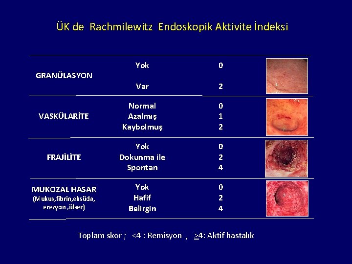 ÜK de Rachmilewitz Endoskopik Aktivite İndeksi Yok 0 Var 2 VASKÜLARİTE Normal Azalmış Kaybolmuş