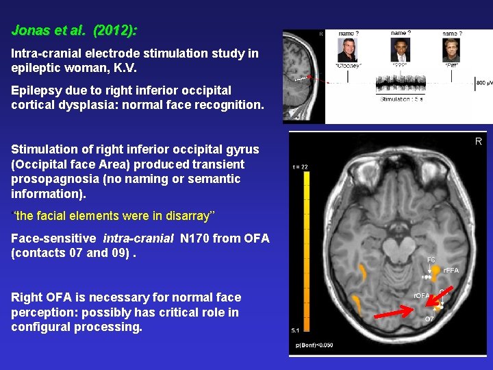 Jonas et al. (2012): Intra-cranial electrode stimulation study in epileptic woman, K. V. Epilepsy