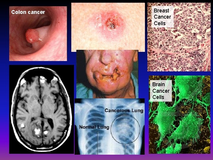 Colon cancer Breast Cancer Cells Brain Cancer Cells 