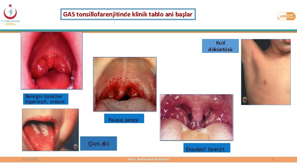 GAS tonsillofarenjitinde klinik tablo ani başlar Kızıl döküntüsü Çilek dili 14. 2. 2022 8