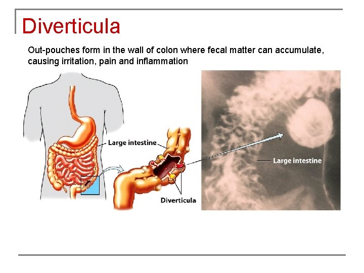 Diverticula Out-pouches form in the wall of colon where fecal matter can accumulate, causing