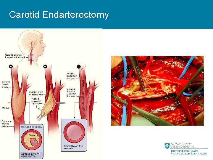 Carotid Endarterectomy 