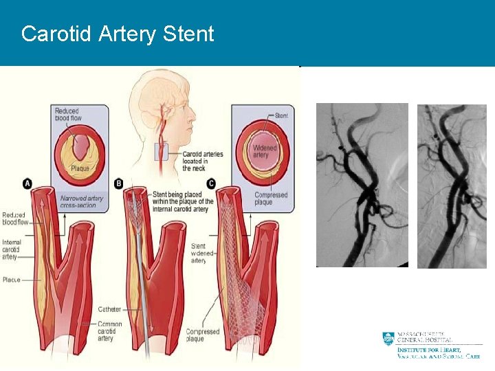 Carotid Artery Stent 18 