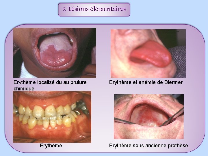 2. Lésions élémentaires Erythème localisé du au brulure chimique Érythème Erythème et anémie de