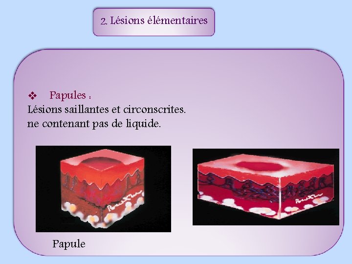 2. Lésions élémentaires v Papules : Lésions saillantes et circonscrites. ne contenant pas de